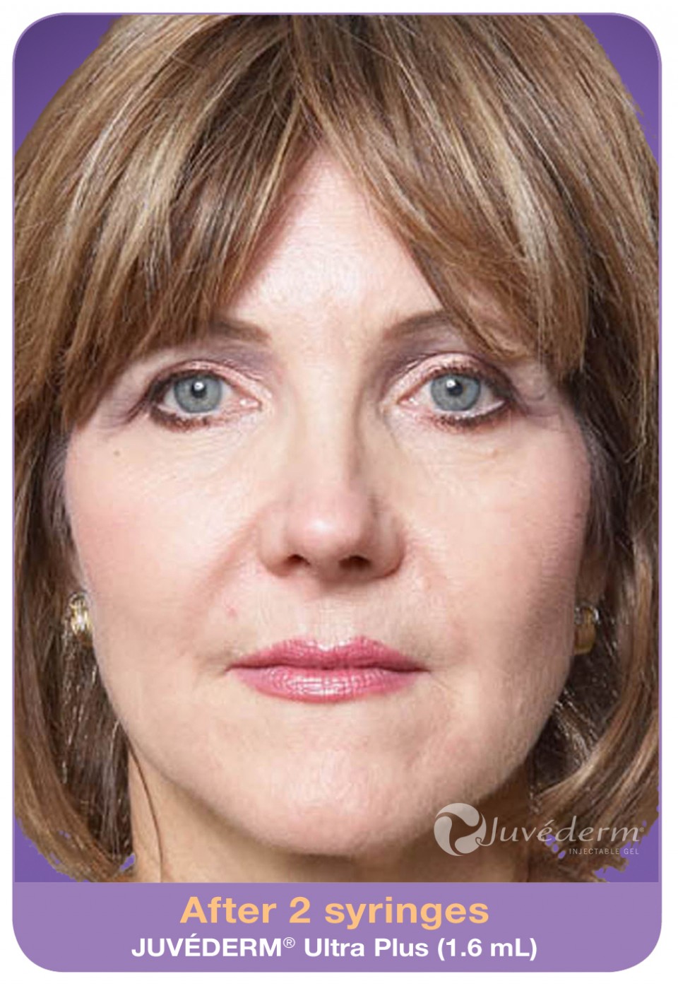 Here is SANDY ...AFTER her JUVEDERM injection treatment