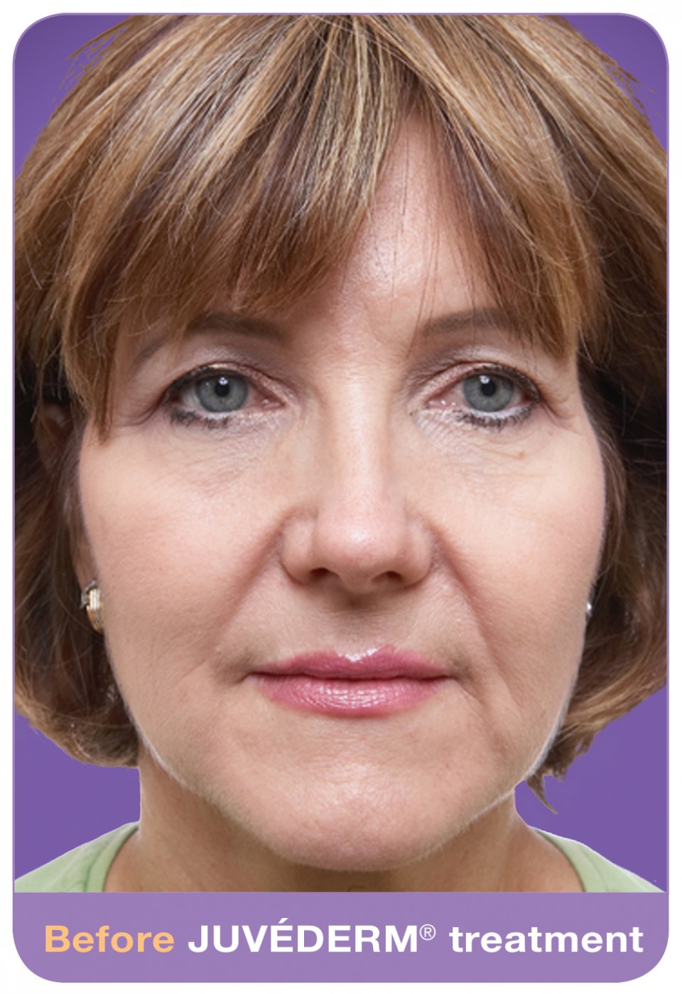Here is Sandy BEFORE her JUVEDERM injection restoration