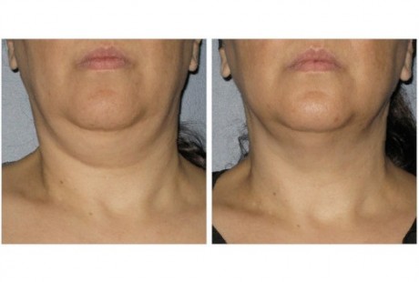 " Double chin " deformity removed using ULTHERAPY ultrasound treatment ! ( photo provided by Dr. Leslie Baumann )