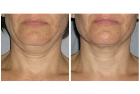 ULTHERAPY takes  YEARS off the appearance of your neck !