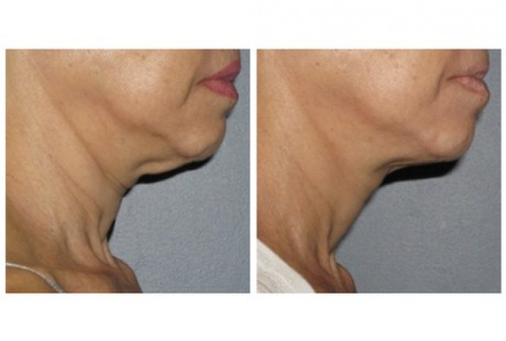 "Turkey neck" eliminated after ULTHERAPY treatment !